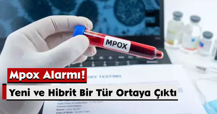 İngiltere’de Mpox Alarmı! Yeni ve Hibrit Bir Tür Ortaya Çıktı