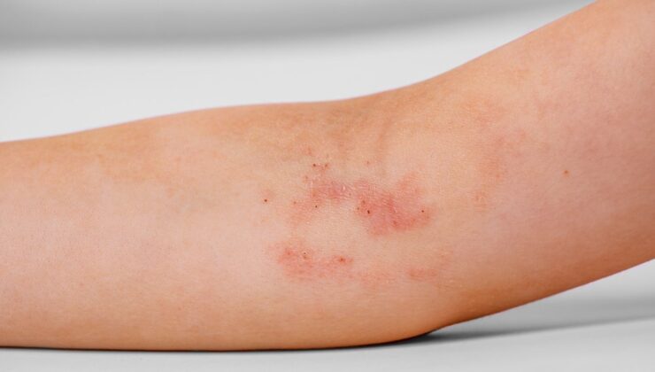 Atopik Dermatit Kimlerde Görülür?